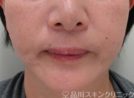 症例NO.34234のAFTER写真