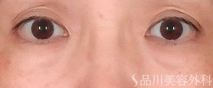 症例NO.70709のBEFORE写真