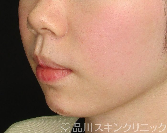 症例NO.69740のAFTER写真