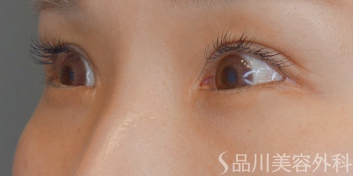 症例NO.71925のBEFORE写真