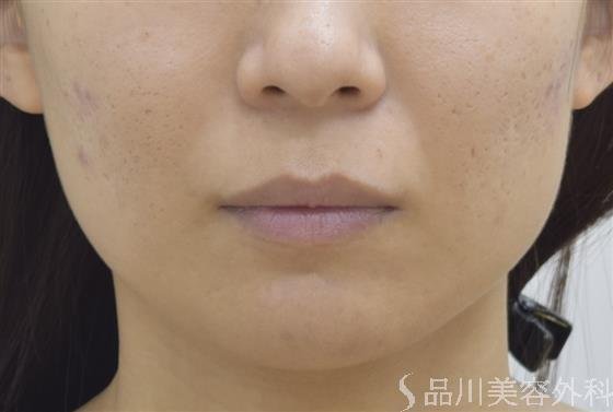 症例NO.47067のBEFORE写真