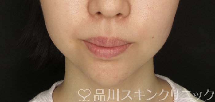 症例NO.69524のAFTER写真