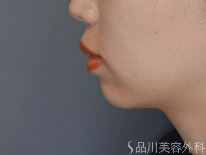 症例NO.71949のBEFORE写真