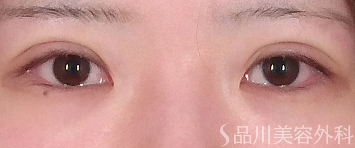 症例NO.69875のAFTER写真