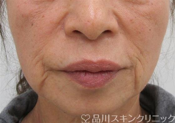 症例NO.40314のBEFORE写真