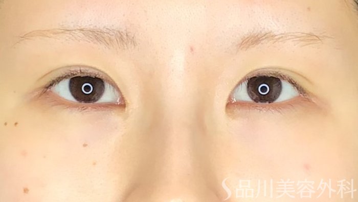 症例NO.69493のAFTER写真