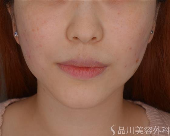 症例NO.51167のAFTER写真