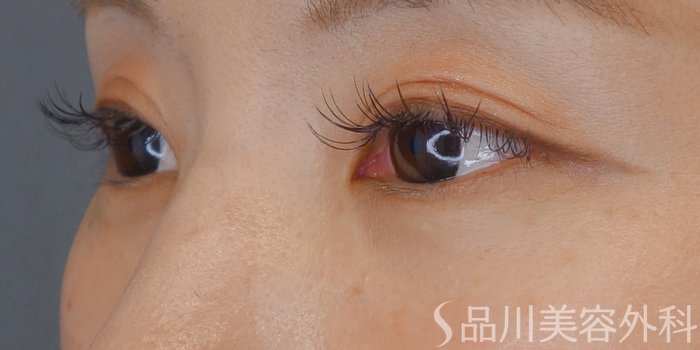 症例NO.69620のBEFORE写真