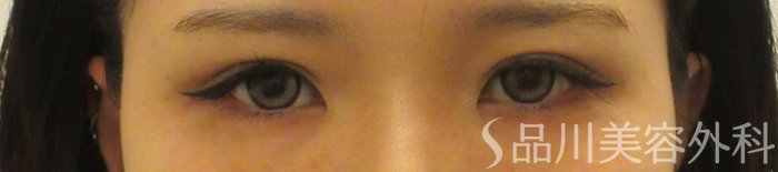 症例NO.73390のBEFORE写真