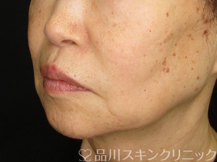 症例NO.68296のBEFORE写真