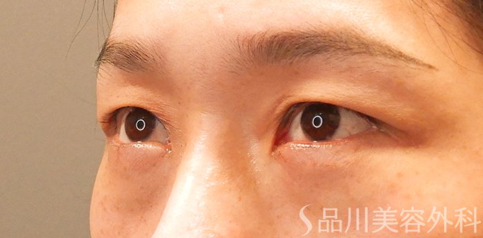 症例NO.69805のAFTER写真