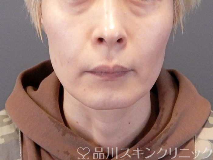 症例NO.63541のBEFORE写真