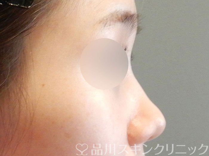 症例NO.63136のBEFORE写真