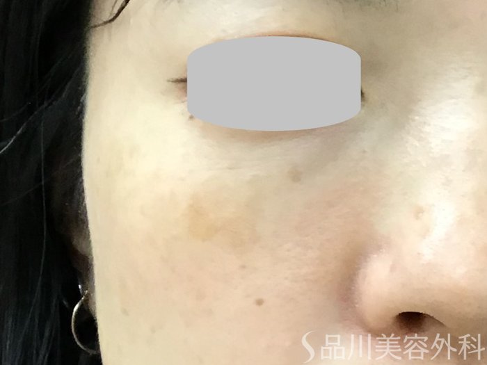 症例NO.67846のBEFORE写真