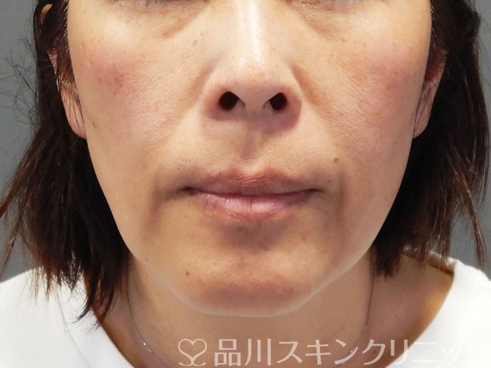 症例NO.69479のBEFORE写真