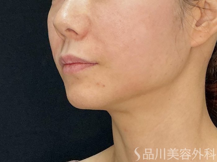 症例NO.72574のAFTER写真