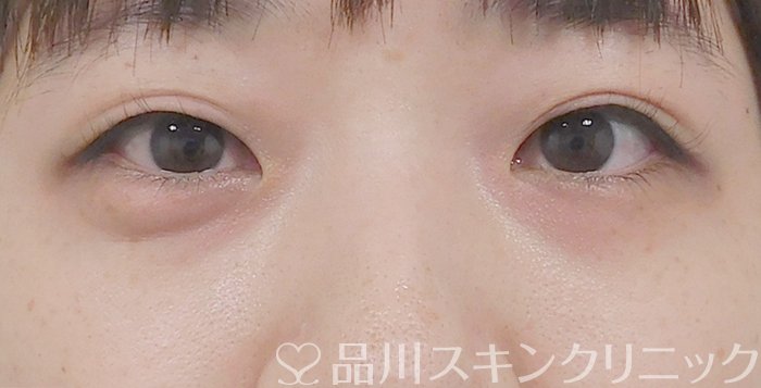 症例NO.63373のBEFORE写真