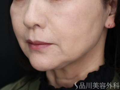 症例NO.74149のAFTER写真