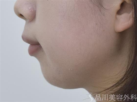 症例NO.46844のBEFORE写真