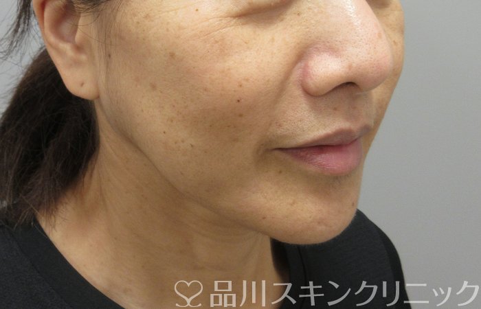 症例NO.74307のBEFORE写真