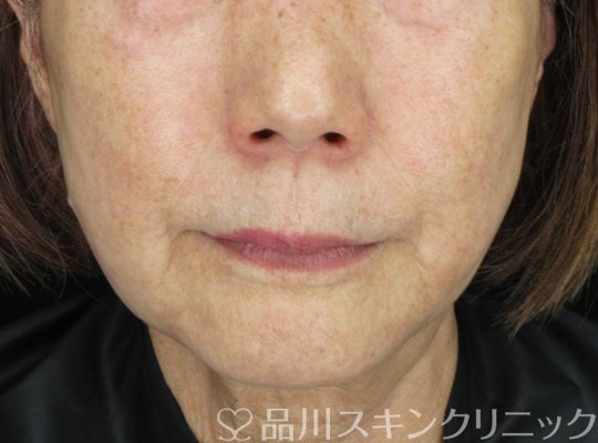 症例NO.65500のAFTER写真