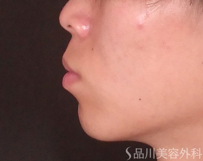 症例NO.70511のBEFORE写真