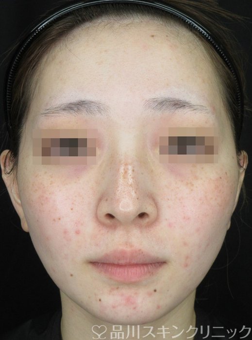 症例NO.70482のBEFORE写真