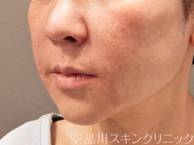 症例NO.69756のAFTER写真