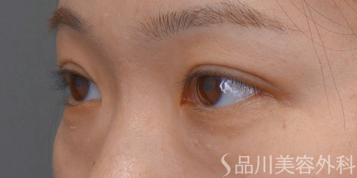 症例NO.74130のAFTER写真
