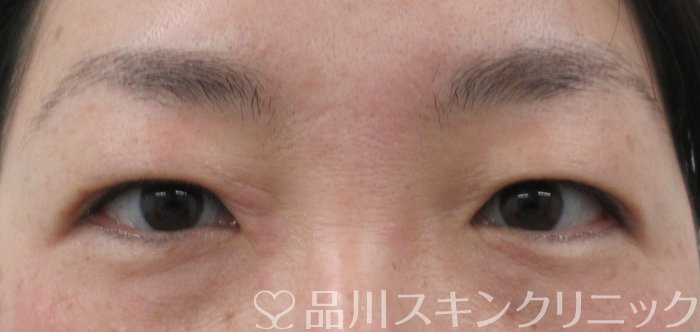 症例NO.65653のBEFORE写真