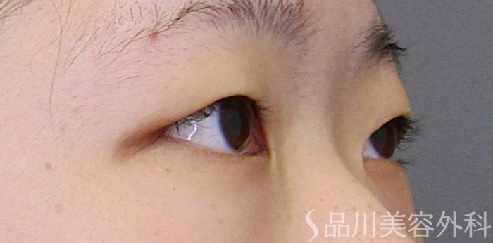 症例NO.75033のBEFORE写真