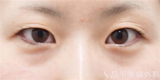 症例NO.41185のBEFORE写真