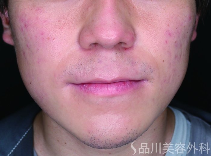 症例NO.72744のAFTER写真