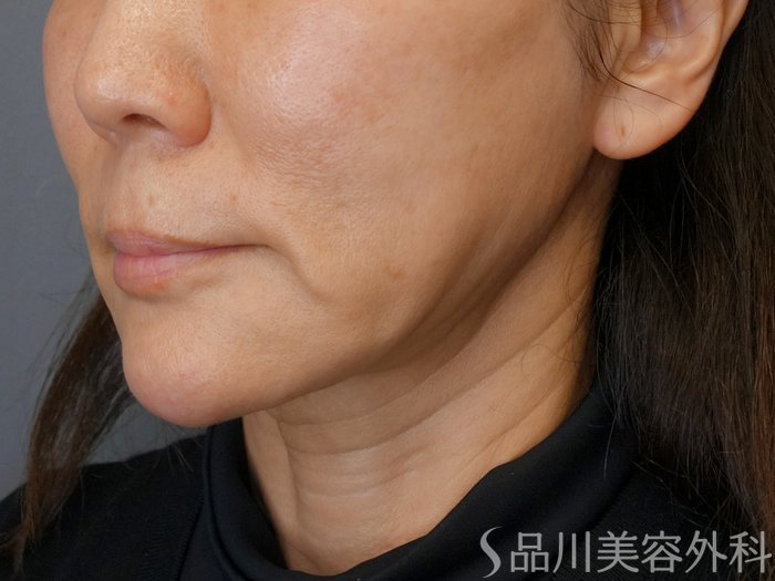 症例NO.72893のBEFORE写真