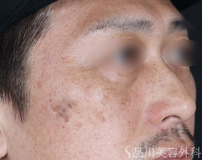 症例NO.73942のBEFORE写真