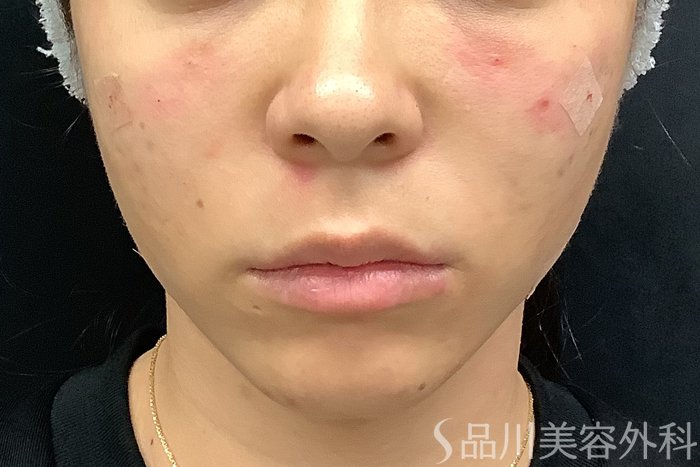 症例NO.67803のAFTER写真