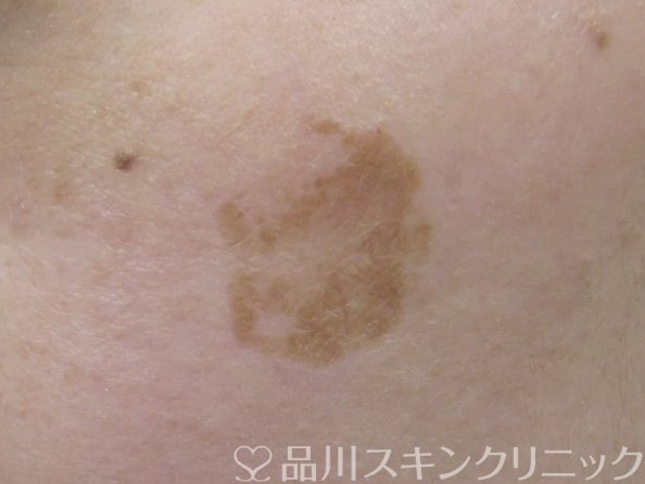 症例NO.64729のBEFORE写真