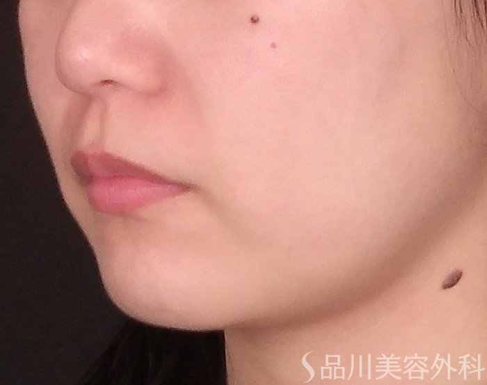 症例NO.70951のBEFORE写真
