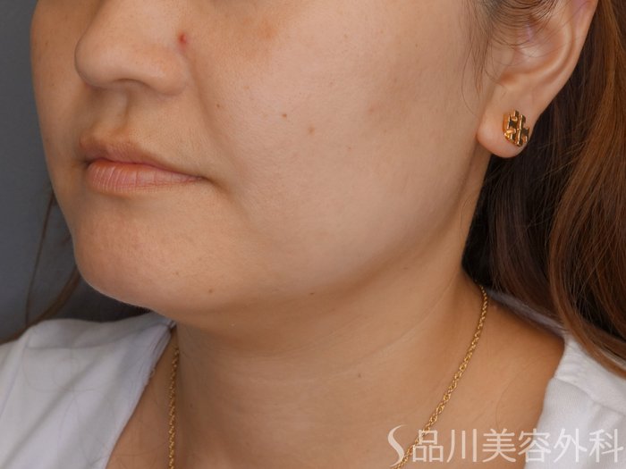症例NO.71634のBEFORE写真