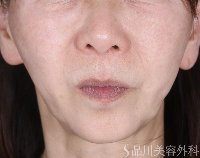 症例NO.73737のBEFORE写真