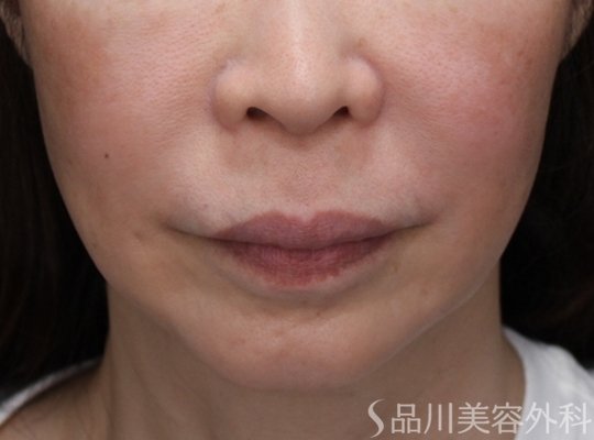 症例NO.73110のBEFORE写真