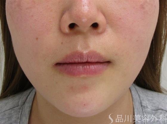 症例NO.43621のAFTER写真