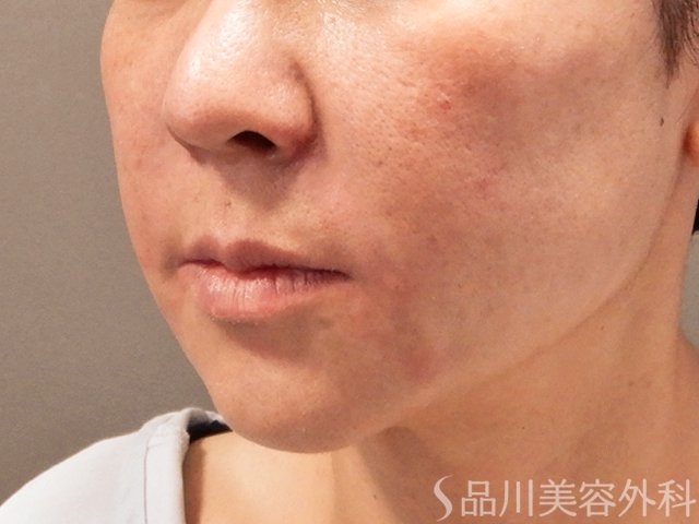 症例NO.69756のAFTER写真