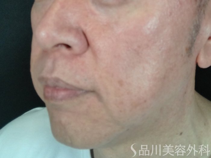 症例NO.70665のBEFORE写真