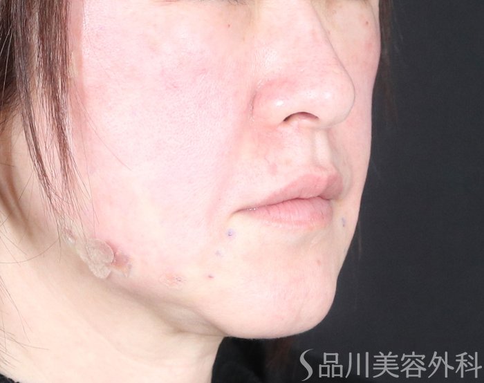 症例NO.73170のAFTER写真