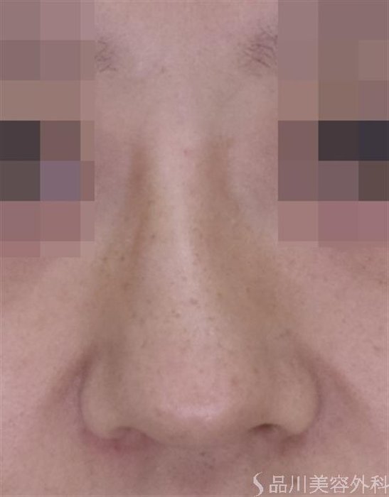 症例NO.51562のAFTER写真