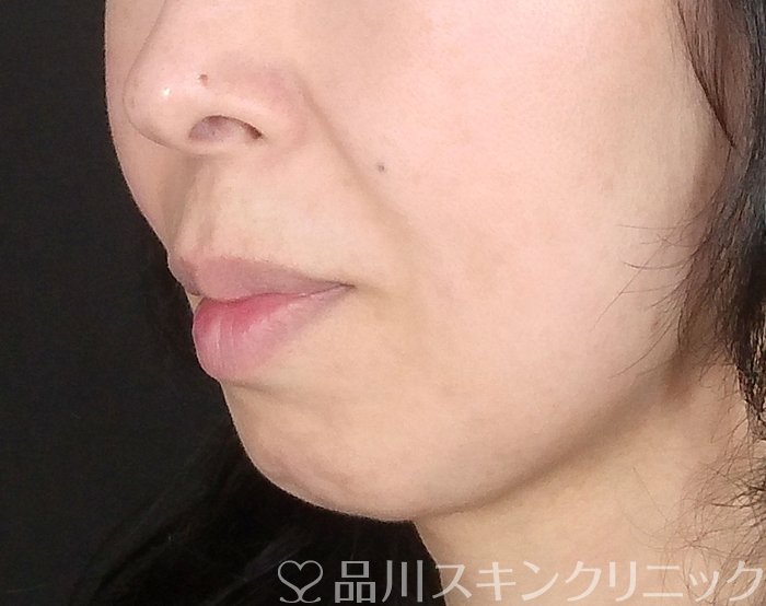 症例NO.69647のBEFORE写真