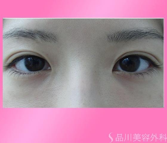 症例NO.14238のBEFORE写真