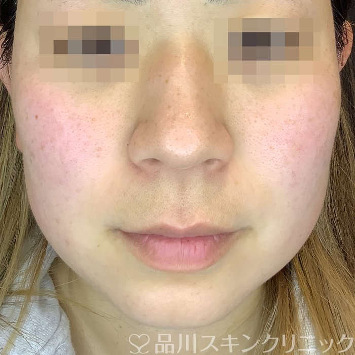 症例NO.62990のBEFORE写真