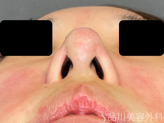 症例NO.66689のAFTER写真
